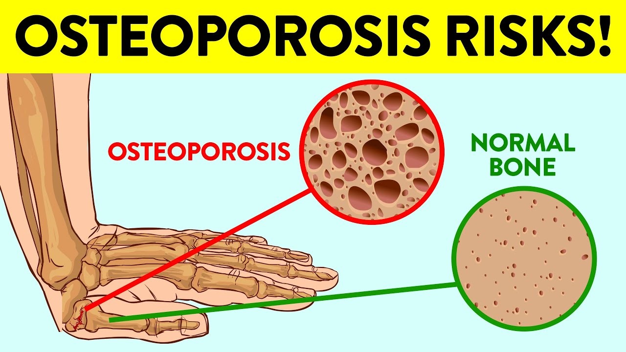 13 Early Warning Signs You’re At Risk For Osteoporosis